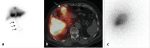 7 SPECT and SPECT/CT in Neoplastic Disease