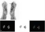 9 SPECT/CT for Infection and Inflammation
