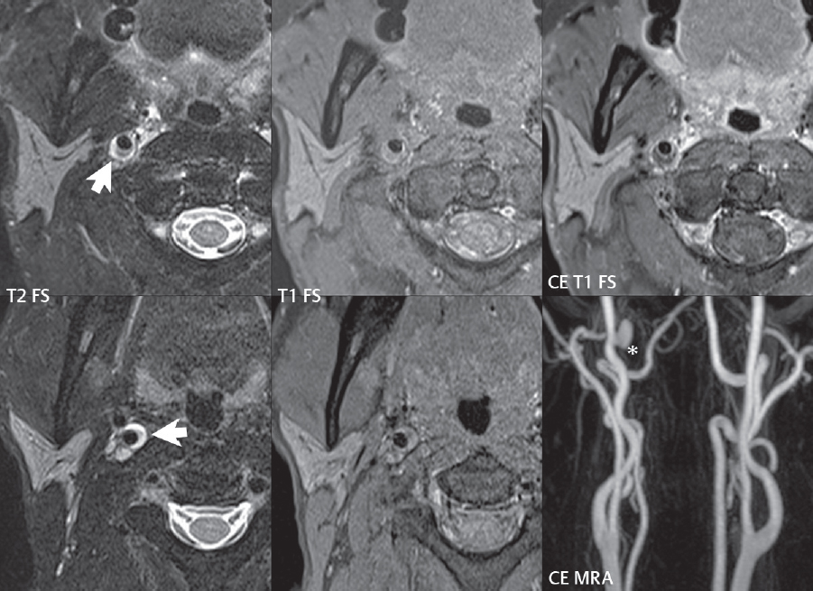 6 Vascular Malformations And Other Vascular Lesions | Radiology Key