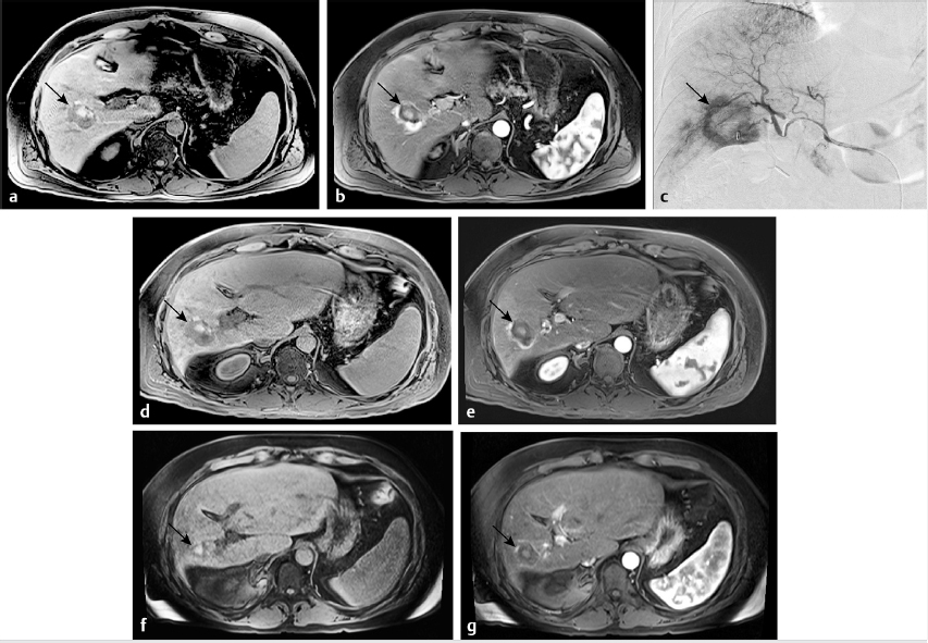 Liver Metastases Ct Scan 3243