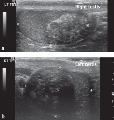 Epididymis Lump Ultrasound