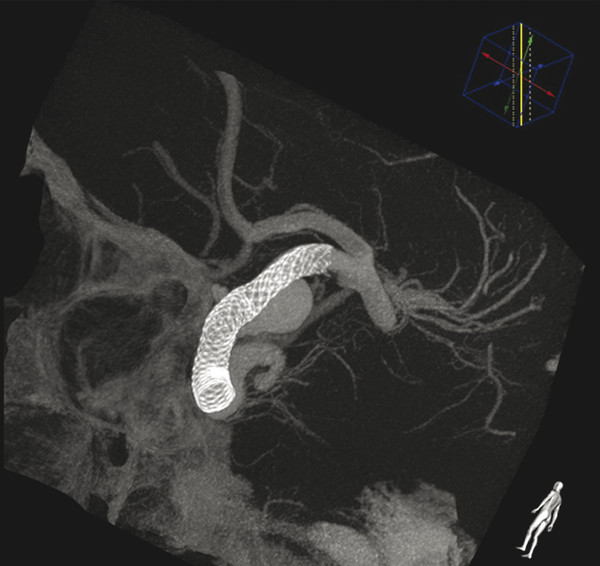 4 Intracranial Aneurysms | Radiology Key