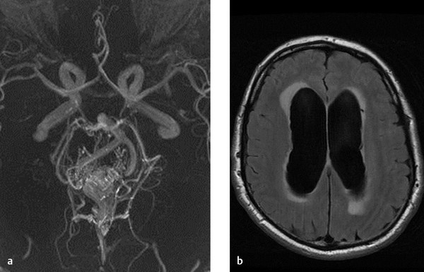 5 Cerebral Arteriovenous Malformations (AVMs) And Dural Arteriovenous ...