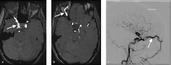 5 Cerebral Arteriovenous Malformations Avms And Dural Arteriovenous Fistulas Davfs 9962