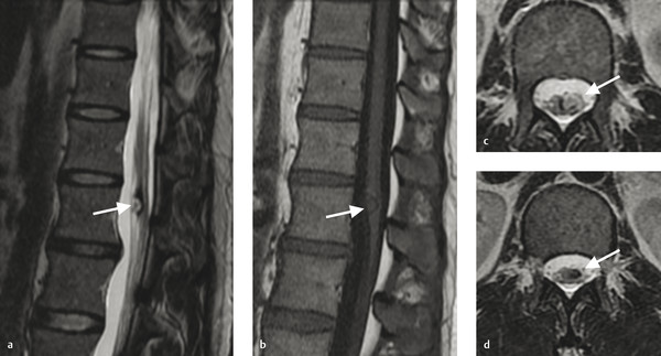 11 Spinal Vascular Disease | Radiology Key