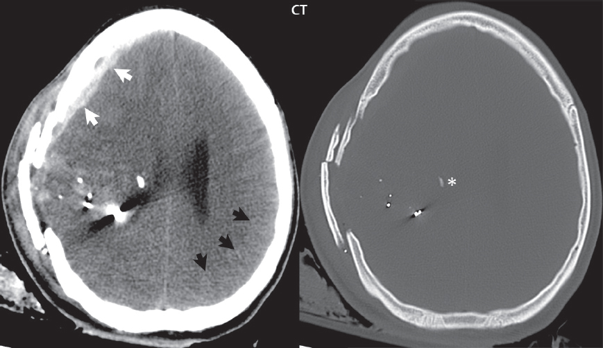 Sharp Force Trauma Radiograph Trauma | Radiology Key