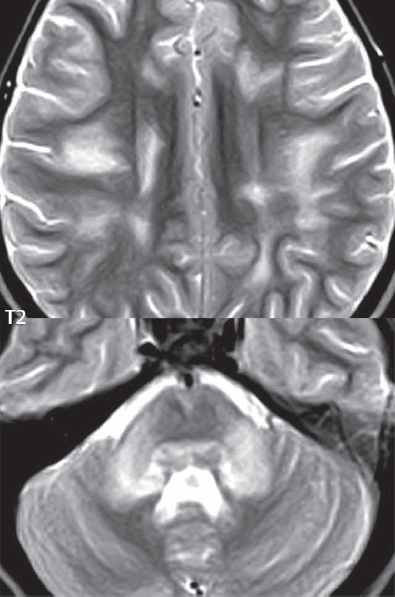 Demyelinating Disease | Radiology Key