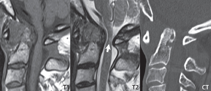 Degenerative Disease | Radiology Key