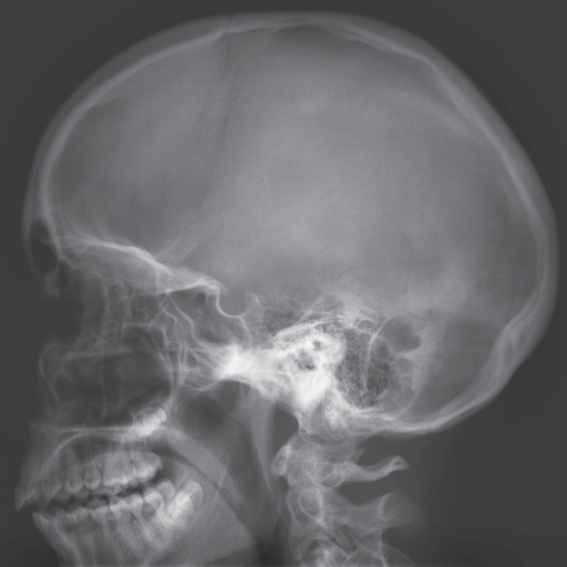 Female Skull | Radiology Key