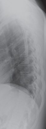 Female Thoracic Spine