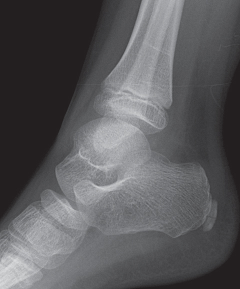 Female Ankle | Radiology Key
