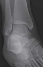 Female Ankle