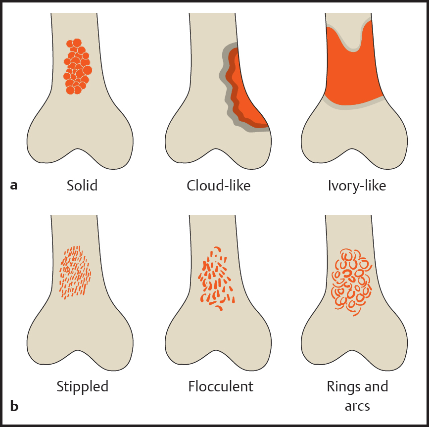 Musculoskeletal Tumors | Radiology Key