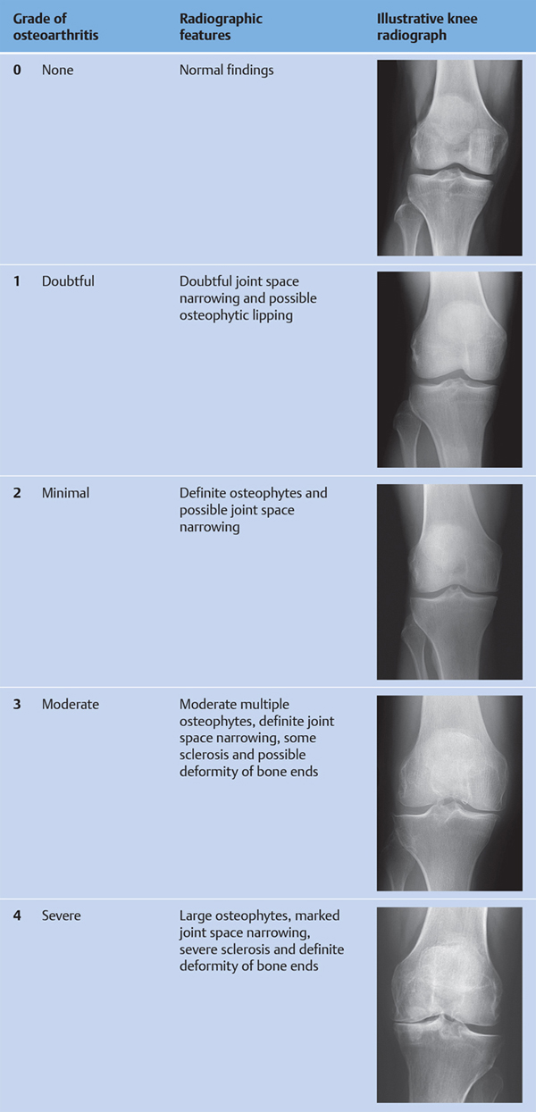 osteoartrita gradul 4