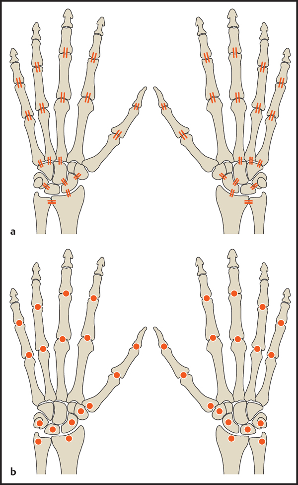 Rheumatoid Arthritis Radiology Key