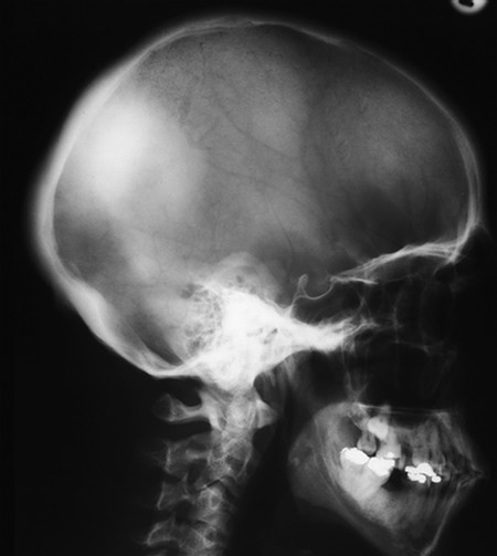 2.2 Osteolytic Lesions and Lesions with Mixed Features | Radiology Key