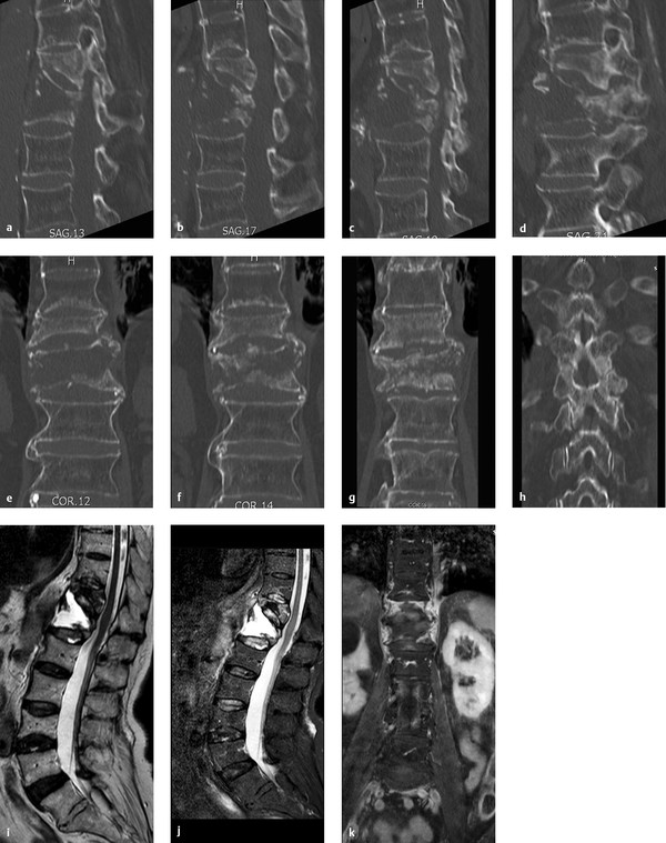 3.2 Oligo- And Multisegmental Changes | Radiology Key