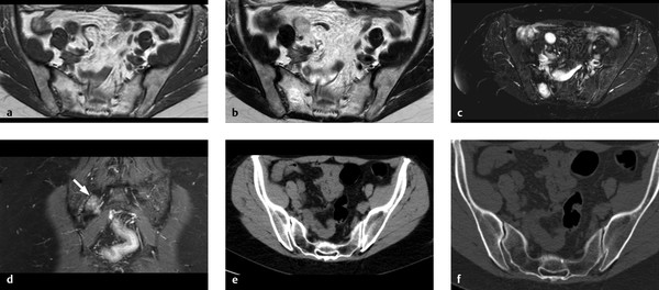 4-2-osteolytic-changes-and-changes-associated-with-decreased-bone