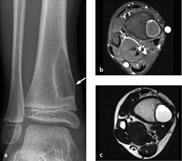 7.2 Predominantly Osteolytic Changes | Radiology Key