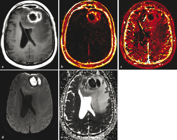 5 Perfusion Imaging: Dynamic Contrast-Enhanced T1-Weighted MRI (DCE-MRI ...