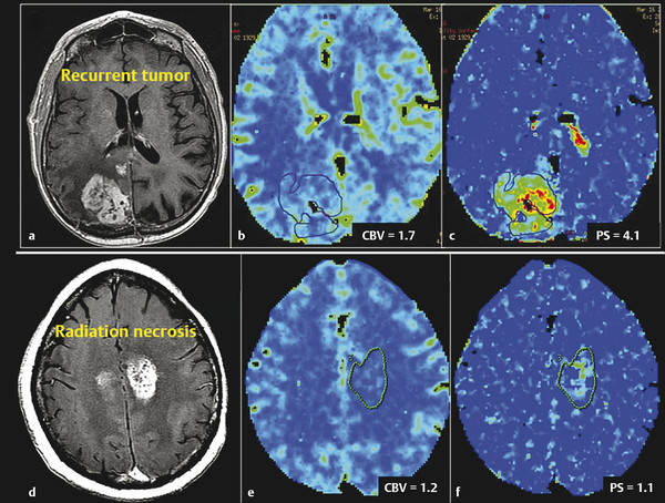 7-perfusion-imaging-perfusion-ct-radiology-key