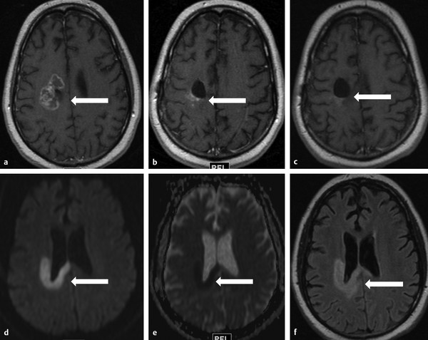 8 Diffusion-Weighted Imaging For Gliomas | Radiology Key