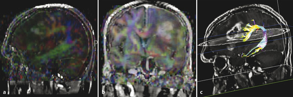 10 Functional MRI And Diffusion Tensor Imaging With Tractography ...