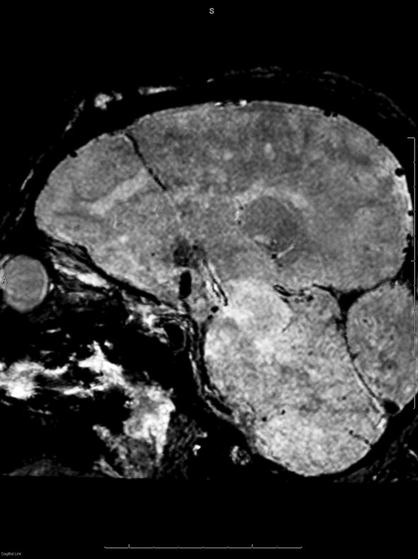 15 Image-Guided Neurosurgery: Intraoperative MRI | Radiology Key