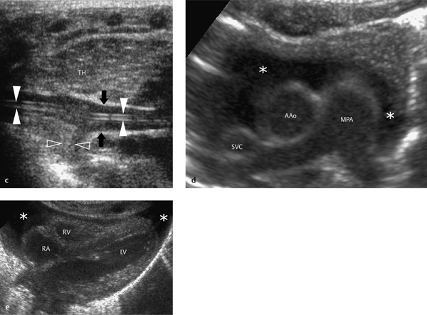 6 Mediastinum | Radiology Key