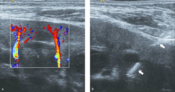 18 Ultrasound Guided Interventional Procedures Biopsy And Drainage