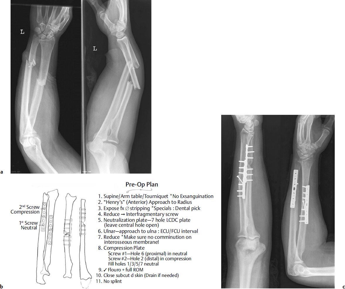 Distal Forearm Fracture - vrogue.co