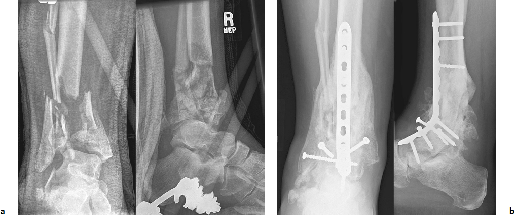open fracture x ray