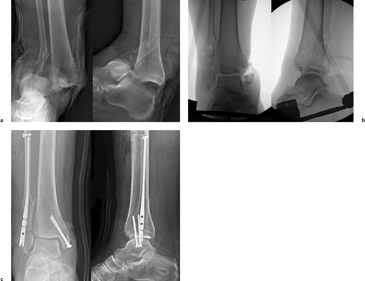 Ankle Fractures and Dislocations - Bút Chì Xanh