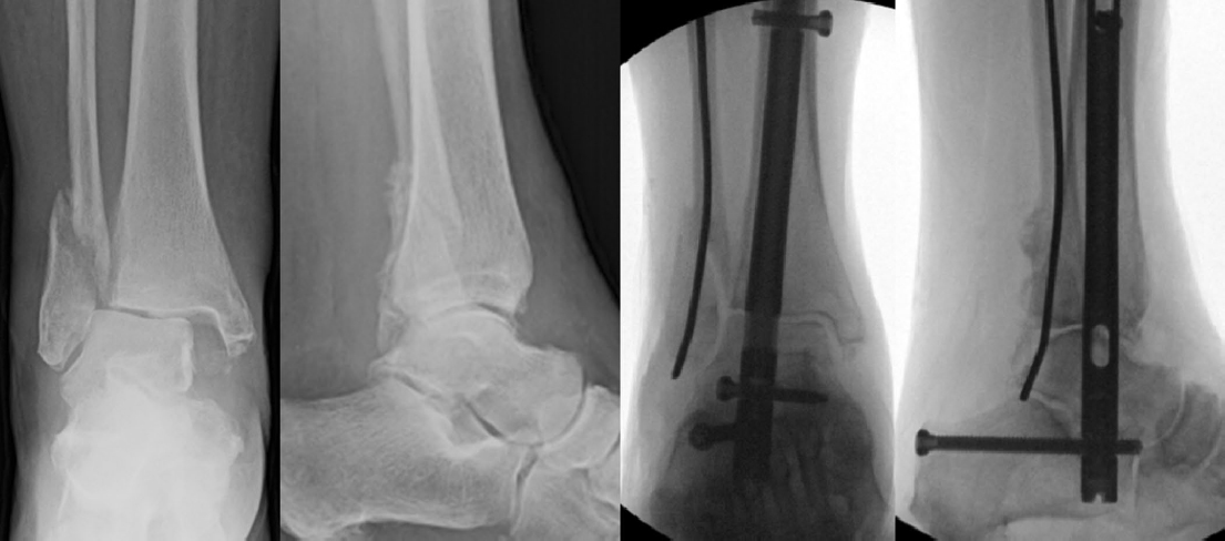 Ankle Fractures and Dislocations