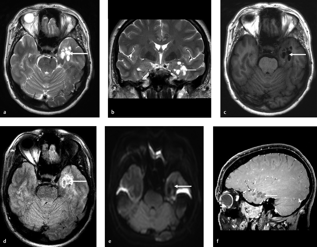 10 Prominent Perivascular Space | Radiology Key