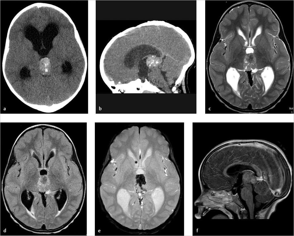 11 Simple Pineal Cyst Radiology Key