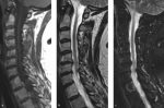 27 Approach to the Solitary Vertebral Lesion on Magnetic Resonance Imaging