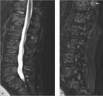 28 Diffusely Abnormal Marrow Signal within the Vertebrae on MRI