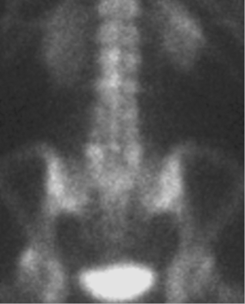 33 Incidental Solitary Sclerotic Bone Lesion | Radiology Key