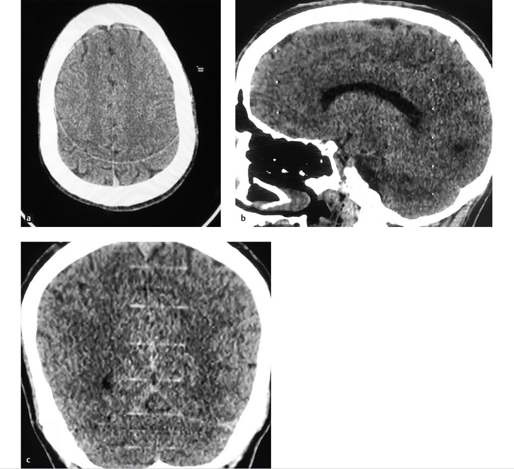 41-computed-tomography-artifacts-radiology-key