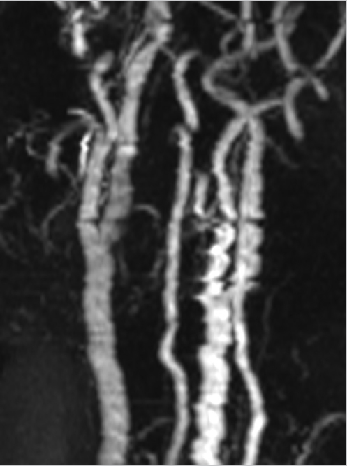 43 Magnetic Susceptibility–Related Artifacts On MRI | Radiology Key