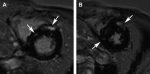 Prognostic Role of MR Imaging in Nonischemic Myocardial Disease