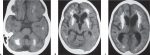 1 Brain and Extra-axial Lesions(Table 1.9 – Table 1.10)