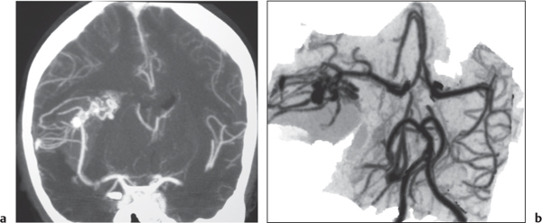 4 Vascular Lesions | Radiology Key