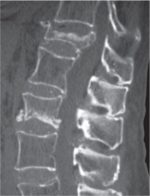 15 Trauma and Fractures: Spine