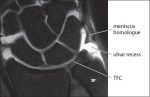 11 Triangular Fibrocartilage Complex