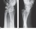 17 Trauma of the Distal Forearm