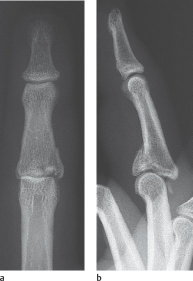 26 Fractures and Dislocations of the Fingers | Radiology Key