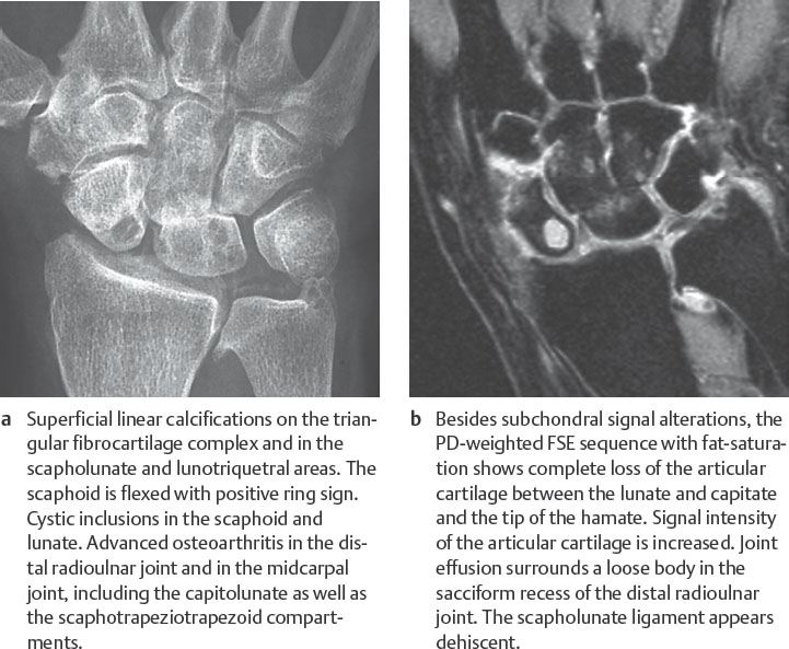osteoarthritis x ray changes