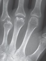 30 Osteonecrosis of the Hand Skeleton